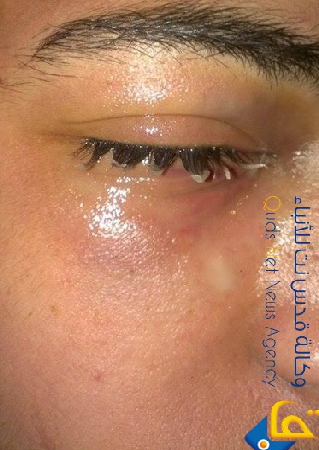 إصابة فتي مقدسي برصاص مطاطي بالعين