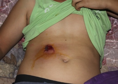 اصابة طفل مقدسي واعتقال شاب في حي الثوري